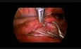 Torakoskopowa operacja zarośnięcia przełyku u noworodka