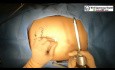 Laparoskopowa chirurgia z powodu torbieli skórzastej lewego jajnika 