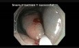 Kolonoskopia: endoskopowa resekcja śluzówkowa subtelnej płaskiej zmiany