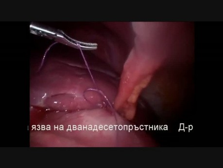 Laparoskopia w perforacji wrzodu żołądka