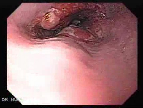 Rak gruczołowy przełyku Barreta - endoskopia terapeutyczna (2 z 7)