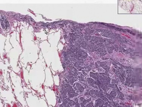 Drobnokomórkowy rak płuc - histopatologia - płuco, tkanka podopłucnowa