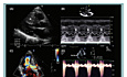 Echokardiografia w kardiomiopatii przerostowej