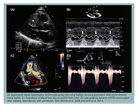 Echokardiografia w kardiomiopatii przerostowej