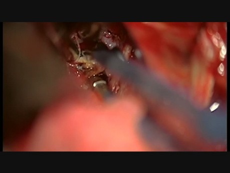 PICA, klipsowanie tętniaka podziału tętnicy kręgowej i móżdżkowej