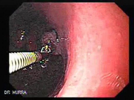 Polipy hiperplastyczne - endoskopia (4 z 14)