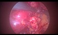 Zaotrzewnowa laparoskopia usunięcia torbielowatego guza nerki