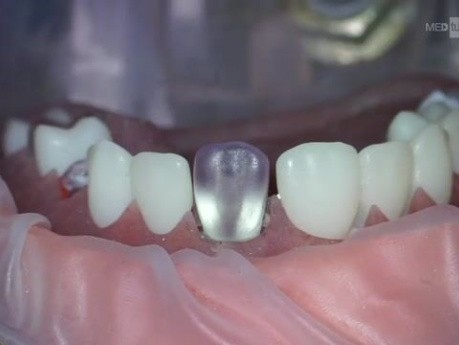 Chirurgia ultradźwiękowa w mikroskopowej chirurgii endodontycznej