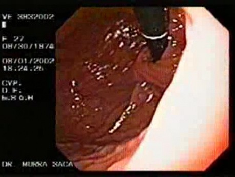 Badanie endoskopowe po wykonaniu fundoplikacji (4 z 5)
