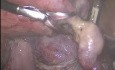 Mięśniak więzadła szerokiego macicy w rzadkiej lokalizacji. Histerektomia laparoskopowa.