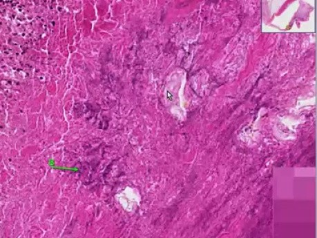 Bakteryjne zapalenie wsierdzia, zastawka aortalna