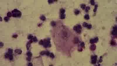 Nierzeżączkowe zapalenie cewki moczowej - NGU - Leukocyty