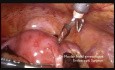 Ostrodyżurowa laparoskopia - ciąża ektopowa