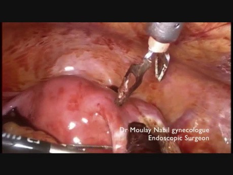Ostrodyżurowa laparoskopia - ciąża ektopowa