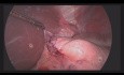 Operacja oszczędzająca narządy w przypadku guza podśluzówkowego części brzusznej przełyku