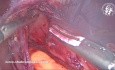 Incidental Mediastinal Lipoma During Laparoscopic Nissen Fundoplication. What is the Surgical Strategy?