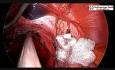 Miotomia Hellera z appendektomią