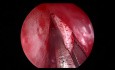 Endoskopowa septoplastyka w przypadku krzywej przegrody nosowej
