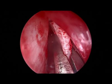 Endoskopowa septoplastyka w przypadku krzywej przegrody nosowej
