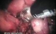 Laparoskopowa brzuszno-kroczowa resekcja odbytnicy (operacja Milesa)