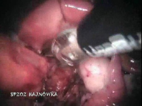 Laparoskopowa brzuszno-kroczowa resekcja odbytnicy (operacja Milesa)