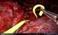 URATS - anatomiczna bisegmentektomia S1-2+S6 z powodu wrodzonej torbielowato-gruczolakowatej malformacji płuca (CCAM)