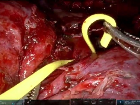 URATS - anatomiczna bisegmentektomia S1-2+S6 z powodu wrodzonej torbielowato-gruczolakowatej malformacji płuca (CCAM)
