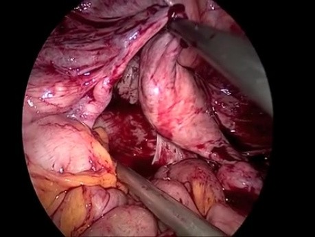 Resekcja esicy - metoda laparoskopowa