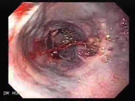 Ostre krwawienie z górnego odcinka przewodu pokarmowego - 2 dni po założeniu podwiązki - bliższe spojrzenie na żylaki
