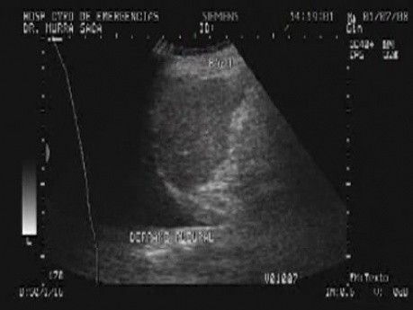 Rak jajnika z przerzutami do żołądka i dwunastnicy - płyn w lewej jamie opłucnej