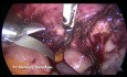 Całkowite laparoskopowe wycięcie macicy