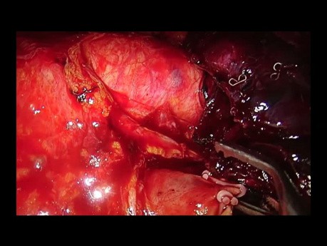 Wideotorakoskopowa lewa górna lobektomia utrudniona z powodu zwapniałych węzłów chłonnych