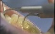 Ultradźwiękowe oczyszczanie zębów