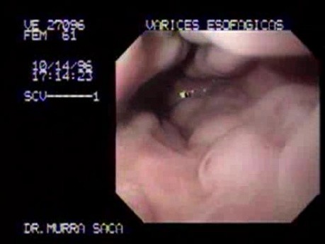 Żylaki przełyku - obraz endoskopowy - przypadek 61-letniej kobiety