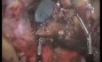 Laparo-endoskopowa jednomiejscowa (LESS) pankreatektomia dystalna i splenektomia