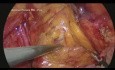 Małoinwazyjne mocowanie siatki w laparoskopowej operacji przepukliny pachwinowej – film dydaktyczny