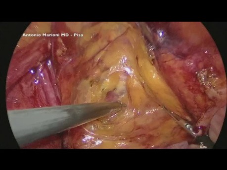 Małoinwazyjne mocowanie siatki w laparoskopowej operacji przepukliny pachwinowej – film dydaktyczny