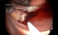 Hybryda ESD/EMR z nacięciem półokrężnym, krwawieniem i klipsami w okrężnicy wstępującej