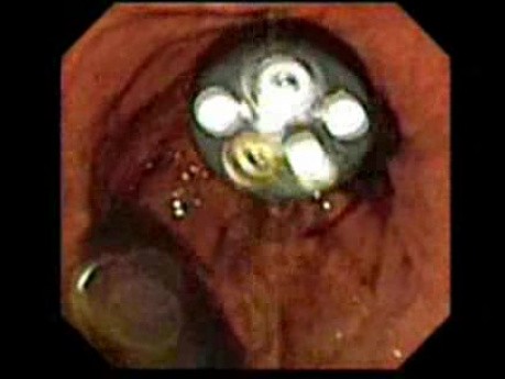 Widok Endoskopu Wprowadzonego Klasycznie - Kamerze Endoskopu W Gastrostomii