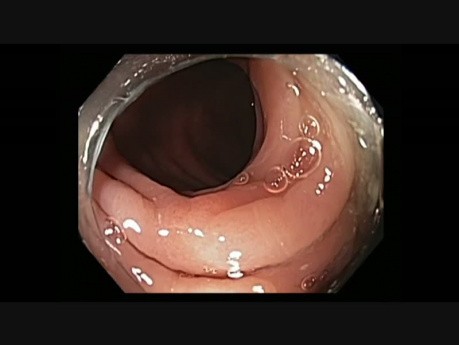 Kolonoskopia - mnogie zmiany - EMR + Hot Biopsy