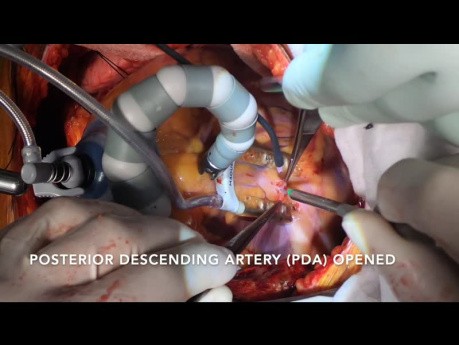 Pomostowanie aortalno-wieńcowe bez użycia krążenia pozaustrojowego u pacjenta z chorobą trzech naczyń