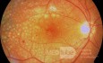 Fotokoagulacja panretialna w proliferacyjnej retinopatii cukrzycowej