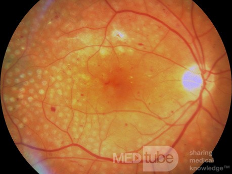 Fotokoagulacja panretialna w proliferacyjnej retinopatii cukrzycowej