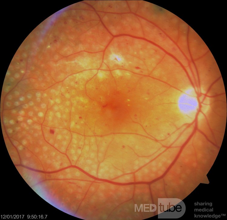 Fotokoagulacja panretialna w proliferacyjnej retinopatii cukrzycowej