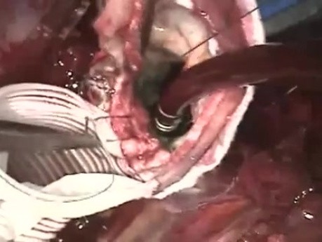 Operacja reparacyjna tętniaka aorty wstępującej