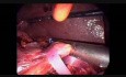 Laparoskopowa pankreatoduodenektomia