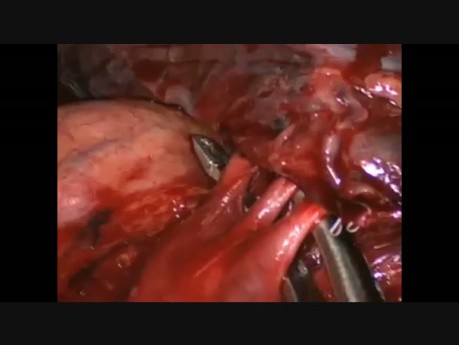 Wariant anatomiczny tętnicy międzypłatowej uwidoczniony podczas wideotorakoskopowej prawej, górnej lobektomii z jednego cięcia