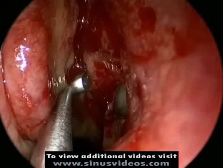 Endoskopowa chirurgia zatok