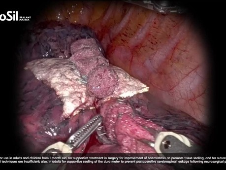 Zastosowanie TachoSil® w robotycznej chirurgii klatki piersiowej – różne przypadki i wskazania, w tym hemostaza, uszczelnianie przecieków powietrznych i limfatycznych