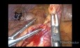 Appendektomia laparoskopowa - OZWR
